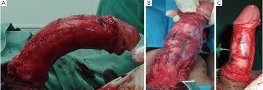 Résultat de recherche d'images pour "penis degloved"