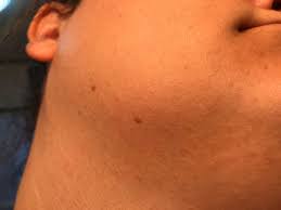 Electrolysis hair removal is the most reliable proven option available today to permanently remove transgender facial and genital hair. Pcos Facial Hair Electrolysis How I Deal With It Hirsutism My Pcos Kitchen