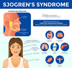 Sjogren S Syndrome Symptoms Causes And Natural Support Strategies In 2020 Autoimmune Disease Sjogrens Syndrome Sjogrens Syndrome Diet