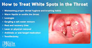 What To Know About White Spots In The Throat Health Throat Lozenge Dental Hygiene