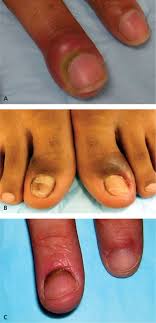 In most cases, white spots appear on the tip of toenails instead of the root can lead to changes in the texture of nails like flaking, tearing and splitting of nail. Evaluation Of Nail Abnormalities American Family Physician