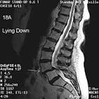 What is a Retrolisthesis? (with pictures)