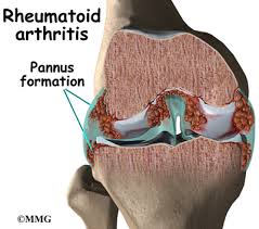 Rheumatoid Arthritis Orthogate