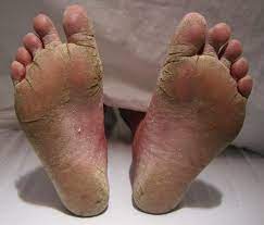 Health Significance Of The Clinical Presentations Of The Fungal Infections Of The Skin Foot Fungus Treatment Foot Fungus Toenail Fungus Remedies