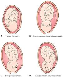 Image result for Brow Presentation