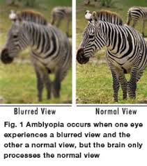 Image result for Amblyopia
