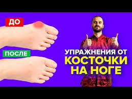 косточка на большом пальце ноги лечение в домашних условиях Pin Na Doske Daniil Susak