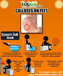 How To Get Rid Of Calluses Naturally Top 10 Home Remedies Foot Remedies Foot Callus Remedies