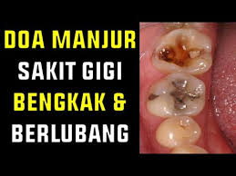 Penyakit ini memang harus diatasi sebelum hamil untuk mengatasi sakit gigi berlebihan. Doa Sakit Gigi Bengkak Dan Berlubang Ruqyah Sakit Gigi Bengkak Dan Berlubang Youtube