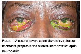 Update On Thyroid Eye Disease