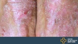 Image result for Lichen Simplex Chronicus