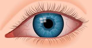 Que Es El Sindrome De Ojo Seco All About Vision