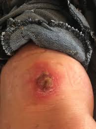 Image result for große winkelspinne biss haut reaktion