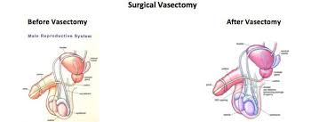 Image result for Vasectomy
