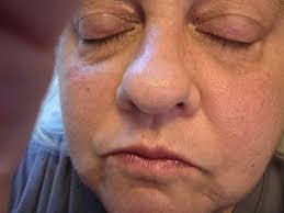 Does this rash look like lupus?