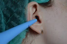 как удалить серную пробку в ухе в домашних условиях Sernaya Probka Udalenie V Domashnih Usloviyah Ear Wax Removal At Home Zdorove Ushi Muzhskoe Zdorove