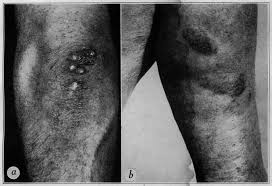 Tuberculosis verrucosa cutis, the usual exogenous form of tuberculosis, is more common in an tuberculosis verrucosa cutis. Https Jamanetwork Com Journals Jamadermatology Articlepdf 520908 Archderm 51 1 005 Pdf