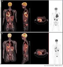 When cancerous tumors form on connective tissues, it is a sarcoma. Malignant Pleural Mesothelioma In A Young Adult With No Known Exposure To Asbestos Archivos De Bronconeumologia