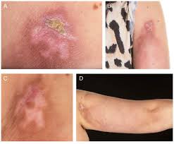 Image result for Panniculitis