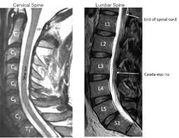 In pediatric patients, widening of the . Understanding Your Cervical Mri Rocky Mountain Brain And Spine Institute