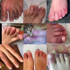 Researchers are still studying the effects of the new coronavirus on the body. Strange Symptoms Of The Virus Covid Toe Coronavirus Covid 19 News Fox10tv Com