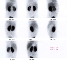 Dimercaptosuccinic acid (dmsa), also called succimer, is a medication used to treat lead, mercury, and arsenic poisoning. Technetium 99m Dimercaptosuccinic Acid Tc 99 Dmsa Scan Of A Download Scientific Diagram
