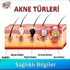 Drnsilver Drngold Kisakisabilgiler Tipta Akne Halk Arasinda Sivilce Olarak Bilinen Ve Cok Cesitleri Olan Cilt Iltihaplanmasinin Tip Urunler Keratin