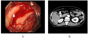 Image result for Diverticular Bleeding