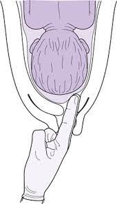 Facilitation Of Skills Related To Childbearing Membrane Sweep Nurse Key