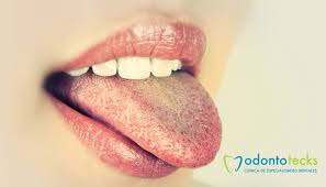 Por Que Tengo La Lengua Blanca Odontotecks