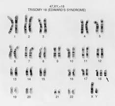 The extra chromosome is lethal for most babies born with this condition. Edward S Syndrome Karyotype 47 Xy 18 Wellcome Collection