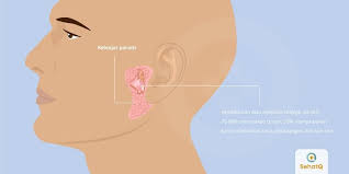 Bagi anda yang ada tumor fibroid/kulit berlebih di tubuh, begini cara menghilangkannya Tumor Jinak Parotis Adalah Pembesaran Yang Terjadi Pada Kelenjar Parotis Yang Berfungsi Untuk Menghasilkan Air Liur Tumbuhnya Tumo Dokter Keluarga Tanda Medis