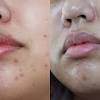 • 2% salicylic acid penetrates deep into the pore to reduce acne breakouts. Https Encrypted Tbn0 Gstatic Com Images Q Tbn And9gctlqe83drjd45z08l6iiu33qr0idtarepxp0lluvfpvzjwj1szc Usqp Cau