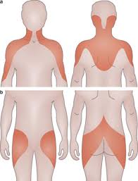 Image result for Polymyalgia Rheumatica