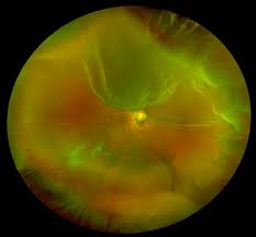 The optomap® retinal exam is fast, easy, and comfortable for all ages. Retinal Holes And Tears Recognizing Pathology Optos