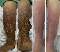Image result for Stasis Dermatitis