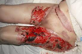 Simply put, wounds cannot heal when necrotic tissue is present. Warfarin Induced Skin Necrosis Progressing To Calciphylaxis Journal Of Plastic Reconstructive Aesthetic Surgery