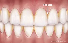 Read full profile you have probably heard that it takes fewe. Plaque Prevention The Key To A Healthy Smile Your Dental Health Resource