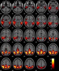 Candidates could download the score card of their cmat exam. Validation Of 18 F Fdg Pet Single Subject Optimized Spm Procedure With Different Pet Scanners Springerlink