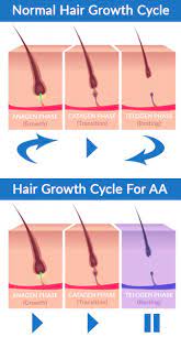 Tips to determine different types of hair: The Different Types Of Autoimmune Alopecia