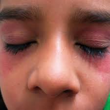 This rash, also called a purpura, is caused by bleeding of tiny blood capillaries under the surface of the skin. Purpuric Lesions Bilateral Periorbital Area After Vomiting Download Scientific Diagram