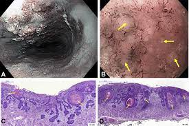 These cysts can occur anywhere on the body, typically present as nodules directly underneath the patient's skin, and often have a visible central punctum. Keratin Pearls In Magnifying Endoscopy Of Superficial Esophageal Squamous Cell Carcinoma Gastrointestinal Endoscopy