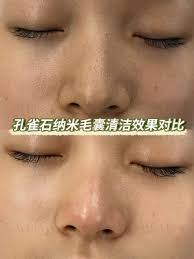 爱维娜毛囊清洁术​我们可以很忙忙的来不及吃饭睡觉但一定不能忘记捯饬自己皮肤也是身材也是女孩子外表下藏着的不仅仅是美丽