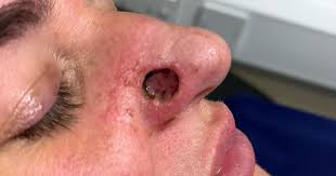 Image result for skin cancer on nose pimple