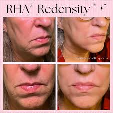 In just 15 minutes Stacey transformed our client's entire lower face! 🤩  @the_cosmetic_pa TREATMENT DETAILS: 💕 Perioral facial filler using just a  1/2 syringe of RHA® Redensity™ 💕 Perfect for smoothing fine