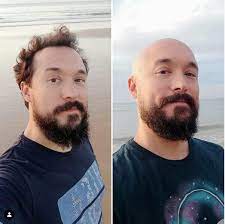 So to summarize on how to look good bald: Balding Young How To Deal With Balding In Your 20s