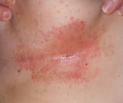 Image result for Intertrigo under breasts