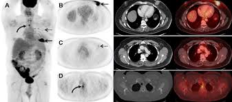 What does breast cancer look like on a mammogram? Fdg Pet Ct Helps Stage Men With Breast Cancer Too