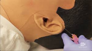 Image result for Ear Nerve Block