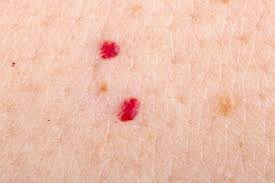 Generally, cherry angiomas are small in size, ranging from the size of a pin head to about a quarter inch in diameter. Genetic Drivers Identified In Cherry Angioma Dermatology Advisor